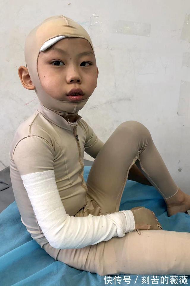 太阳能|热水器老化爆裂烫伤6岁男孩,治疗费已超百万,家长始终不愿放弃