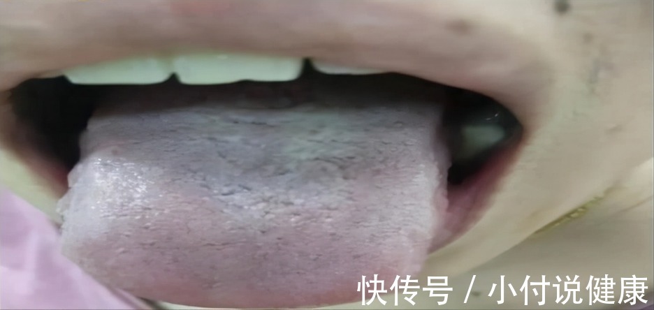 体质|两个位置测血瘀，一个中成药化淤血，4种血瘀体质了解一下