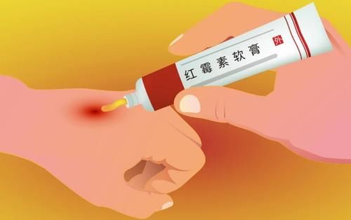 过敏反应|几块钱的红霉素软膏很实用,一般治疗什么?这3种疾病可以尝试