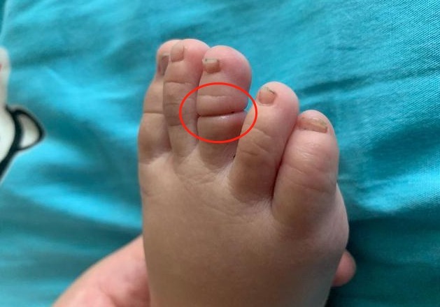 宝宝|2岁宝宝脚趾有“虫子”，妈妈连忙带去检查，医生幸好来得及时