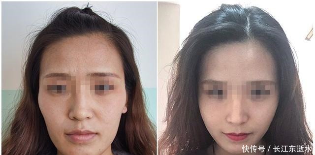 同样是做“脂肪填充”,差别可能就在这里