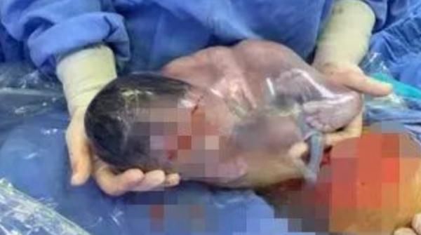 胎膜囊剖宫产术|神奇！这名早产宝宝出生竟自带“金钟罩”