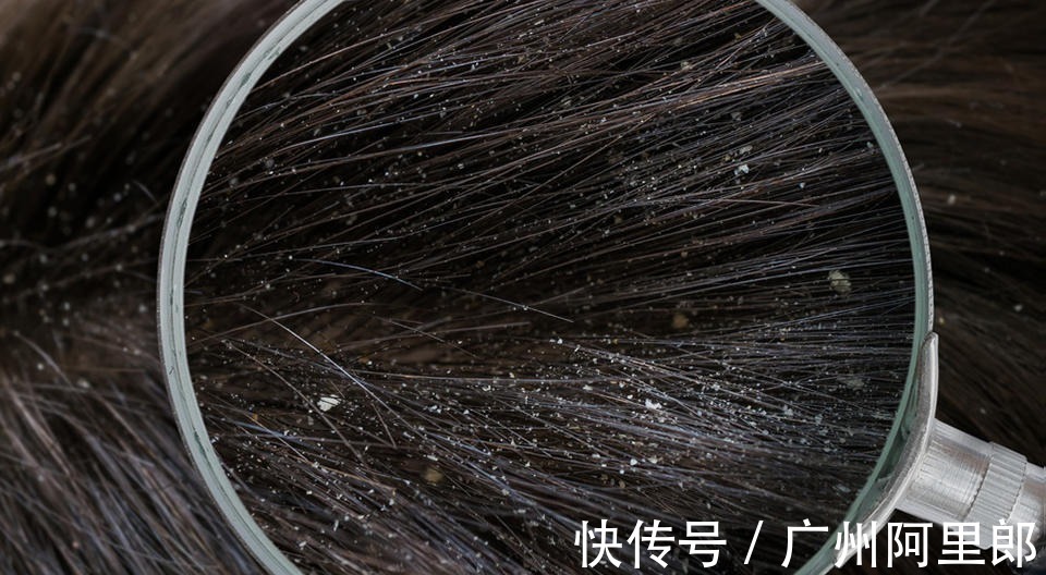 真菌|关于头屑，这篇全是干货！