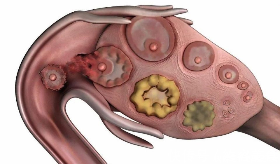 卵巢早衰|试管误区多,害你不敢做,正确面对,拥抱宝宝