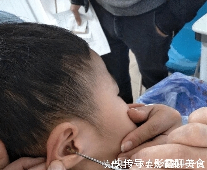 医院|孩子生下来就没掏过耳朵，又长又宽的耳屎堵住耳道，家长需警惕