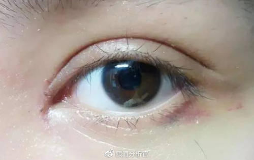 内眼角开太大了怎么办？是缝合好还是皮瓣转移修复好？