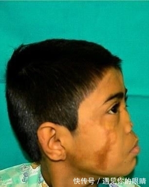 额头|国外小男孩鼻子长在额头上,看了他的经历,真是坚强的表率