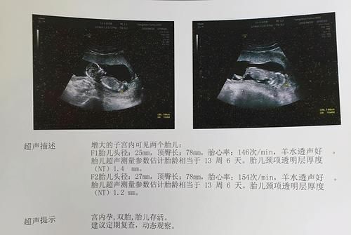 发育不良|双胞胎在子宫里有多“热闹”？医生：打架争地盘都是常事