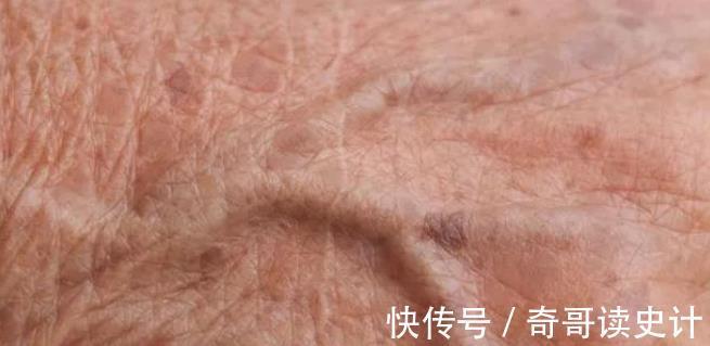 血脂|高血脂“帮凶”已找到,脸上有这3异常,多半血脂已超标,早就医