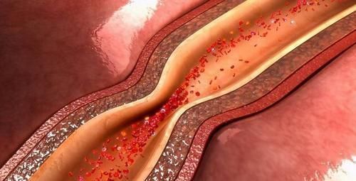 慢跑|得了冠心病,需要保持哪些习惯,方能健康“没事”呢?