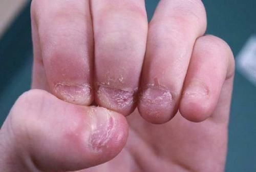 家长|爱“咬指甲”的孩子,长大后是什么模样?两种结局可预料