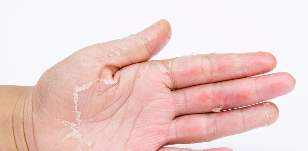 皮肤|湿疹太顽固家里小小的‘它’,让你一周彻底根治,皮肤焕发生机