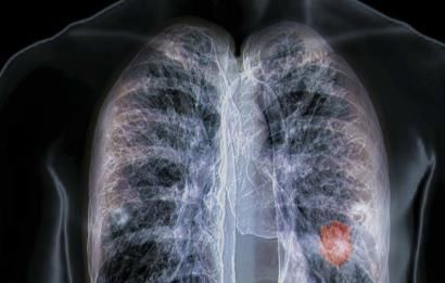 乳腺结节|身体四个部位长了结节，最好定期检查，癌症可能已经”盯上“你了