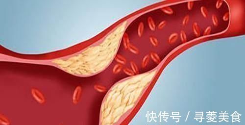 肌腱|血脂高的人,身体可能会有6个表现,多吃两物,帮你平稳血脂!