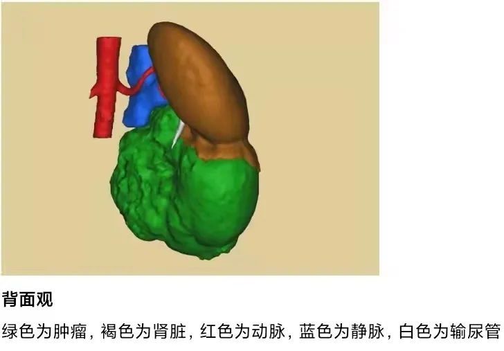 囊肿|女子忽视体检肾肿物，两年多后长成15厘米肾癌！医生提醒→