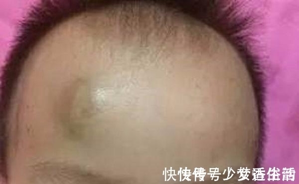 婆婆|2岁宝宝头上磕个包，婆婆嫌弃妈妈大题小作，事情结果让全家崩溃