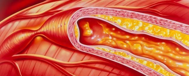 高血压患者谨记少吃2物,坚持2事,血压慢慢降回“安全线”