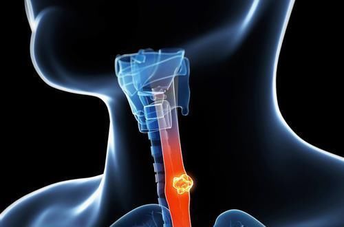 樊代明|如果不幸患了癌,是不是只要动手术切除就可以了,没那么简单
