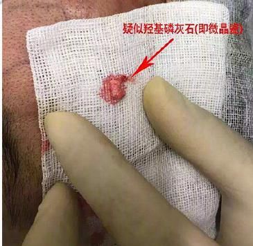 鼻尖|鼻修复时取出的东西都有啥？感受一下！