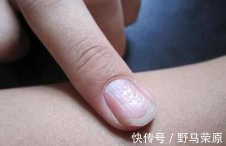 绿脓杆菌|指甲出现这些变化, 它在暗示你的身体里有病!