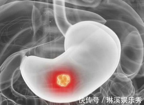 碳酸饮料|消化科医生：2招可“剿灭”幽门螺杆菌，可惜很多人坚持不下来