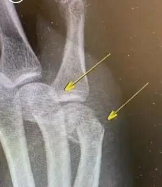 爸爸|辅导作业又“出事”了!爸爸气到捶墙,把自己打骨折……