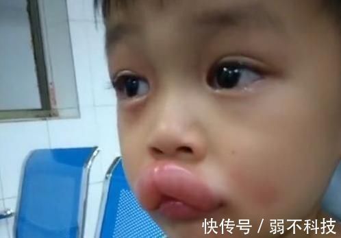 香肠嘴|熊孩子偷吃了一颗葡萄,嘴巴变成了香肠嘴,医生看了都憋笑