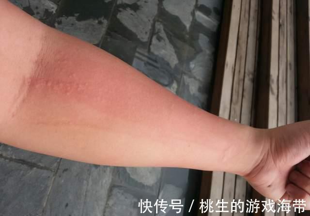 吸烟|注意:皮肤有三个异常表现,尽早查查肺