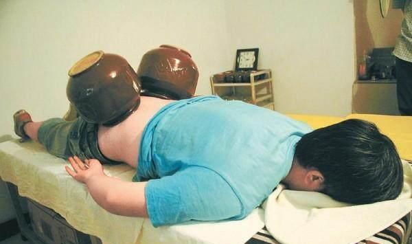  好处|拔火罐居然会有那么多好处，也有三大误区，一件事一定不能做！