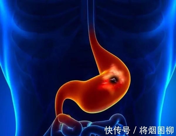 穷癌|胃癌为什么叫做穷癌?富人就不会得胃癌吗?