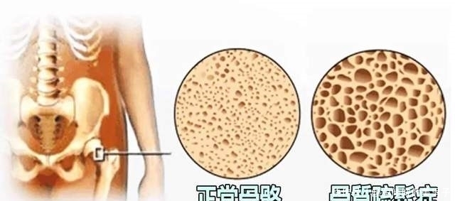 喝骨头汤能补钙?小心你只是补了个寂寞!真正补钙的食物是这些