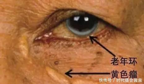 甘油三酯高|甘油三酯“害怕”1物,并不是洋葱,饭后吃一点,血脂或悄悄降