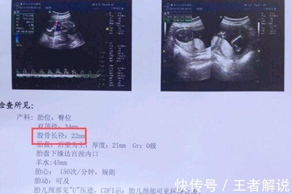 症状|在孕期，“怀男宝”的孕妈在孕检时，多数有几种症状，来自测一下