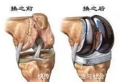 要点|全膝关节置换靠谱不？能用多长时间？祥和骨外科专家为你剖析