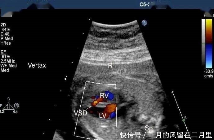  胎儿室缺，超声医师心中的痛