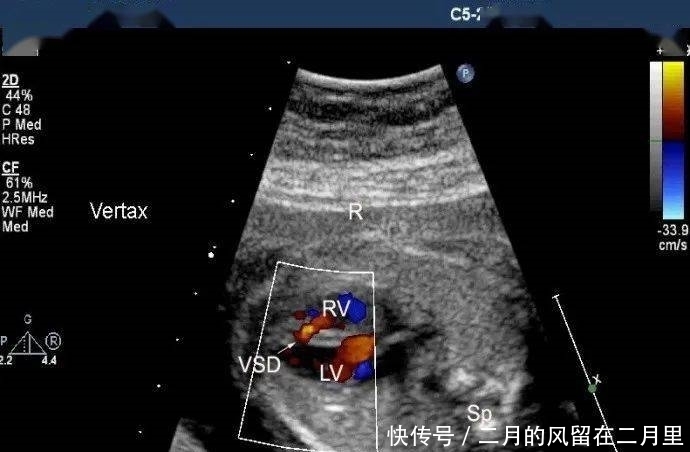 胎儿室缺,超声医师心中的痛