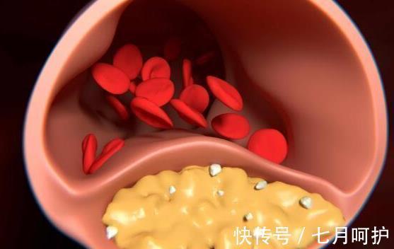 伤口处|内分泌医生:经常做4件事,从高血脂到脑梗可能只需要半年