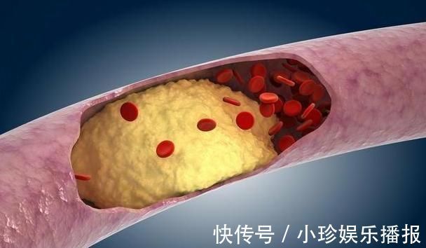 高血糖|高血脂人群，牢记：常吃1物，稳定血脂清理血管，赶走健康隐患！