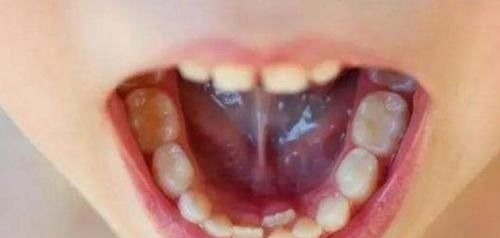 脱落|孩子“乳牙”脱落别着急扔,关键时刻能救命不懂为啥尽快了解下