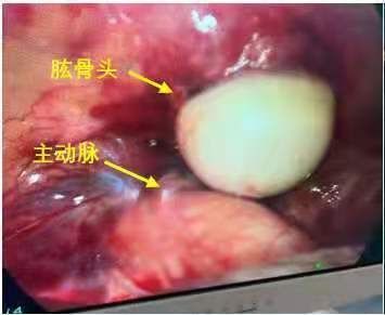 王海涛|去哪儿？中年女子肩部突然少了块骨头，原来“穿越”到这里