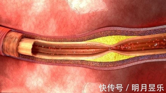 低密度脂蛋白|降血脂、软化血管、清理血管垃圾，不能只依靠药物，更要依靠自己