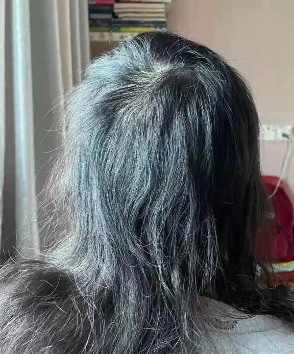 拔毛癖|杭州初二女孩发量越来越稀少！医生指导半年，控制住了……
