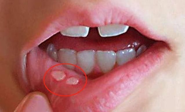 胃中感染幽门螺旋杆菌,身体多有3大变化,若一个不占,值得高兴