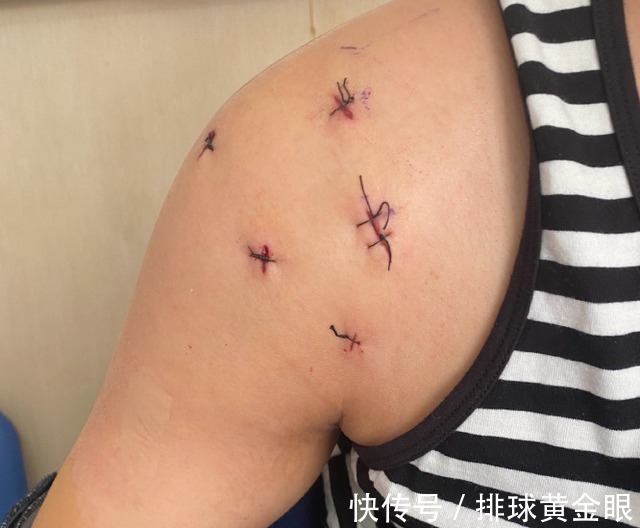 右肩|颜妮右肩植入8枚钢钉，还将进行右膝修复，朱婷手术时间牵动人心