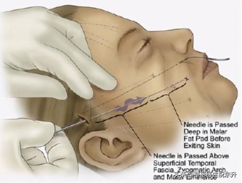 线雕6个月后脸仍旧凹凸不平,问题出在哪?还能救吗?