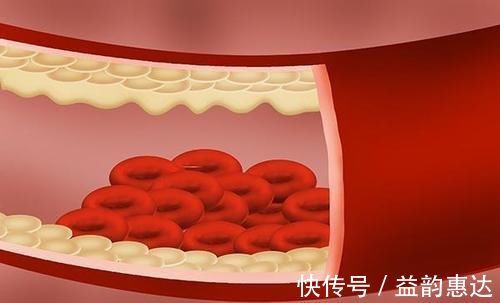 中老年人|体内有血栓的人,睡觉时,身体会有怪象出现,若你也有,趁早检查