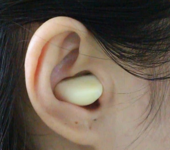 大蒜放耳朵里效果太好了,关于大蒜放耳朵里的