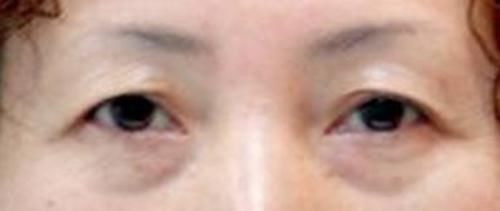 上睑下垂眼无神,做个双眼皮手术就能搞定吗?