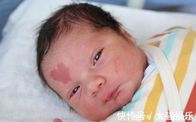 产科医生|胎记咋来的产科医生除了遗传,还与孕期的这3种行为有关