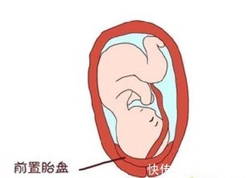 孕晚期|胎儿前壁好还是后壁好,胎盘前壁优劣势各有两点,孕早期早知道